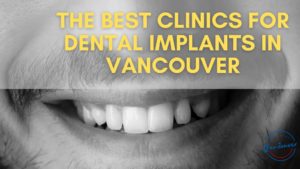 Best Dental Implants in Vancouver