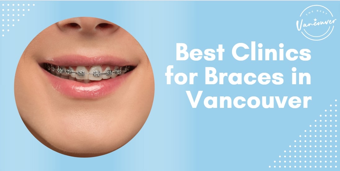 5 Best Clinics for Braces in Vancouver
