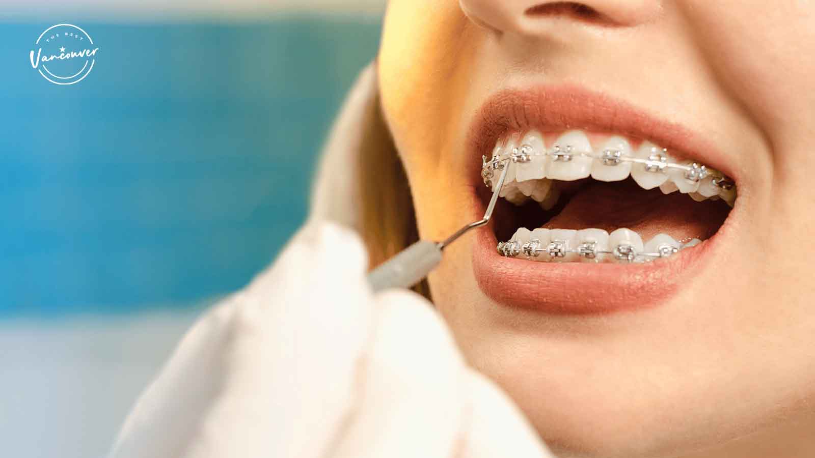Best Clinics for Braces in Vancouver