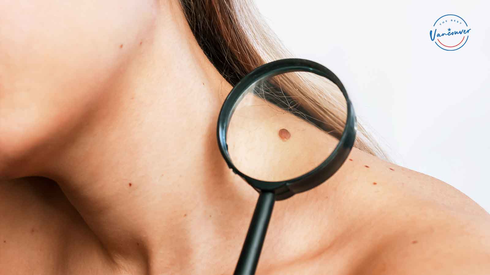 Best Clinics for Mole Removal in Vancouver