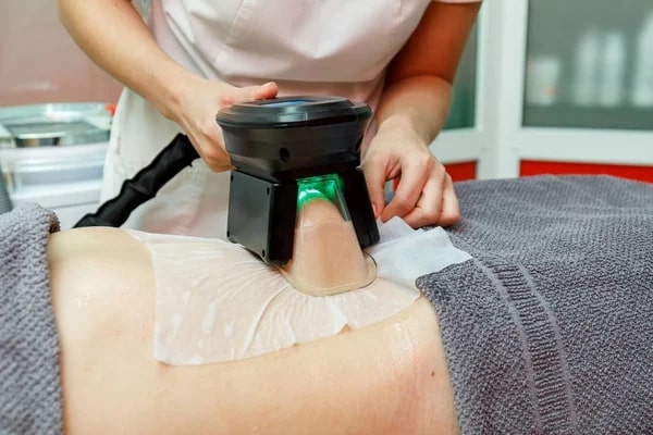 What areas can CoolSculpting treat
